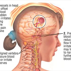 Head On Headache Medicine - Just Where You Should Look For Information About Migraines