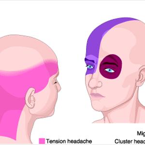 Postictal Headache - How To Start Preventing Migraine Headaches - Get Relief Fast