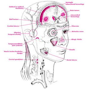 Mirena Migraine Videos - What Are Abortive Migraine Medications